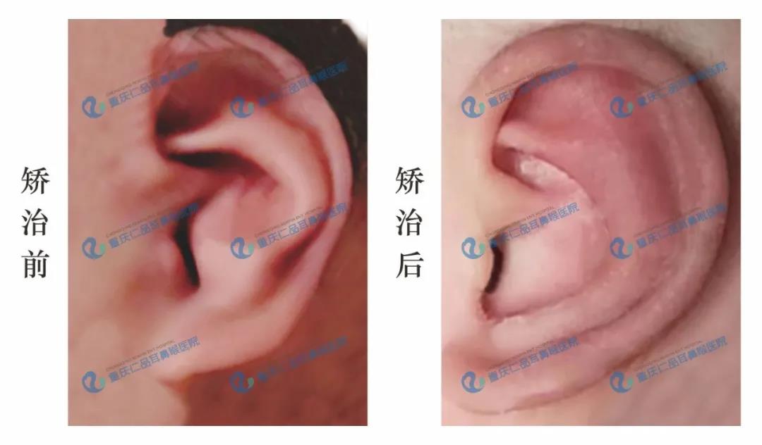 小耳畸形